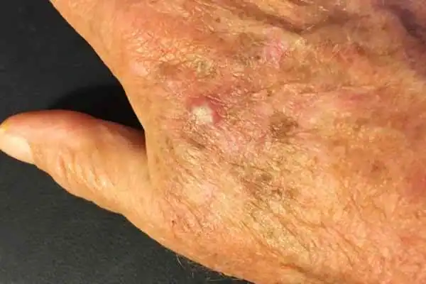 Cryopen For Actinic Keratoses 1 Image of Actinic keratoses Wembley on a person hand